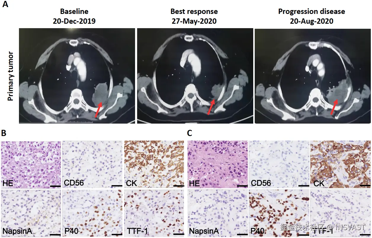 图3  患者在克唑替尼治疗前后的胸部计算机断层扫描(CT)和组织病理学检查 (A) 患者原发肿瘤在基线期(左)、最佳应答期(中)和疾病进展期(右)的CT扫描图像。红色箭头指向恶性病灶。 (B) 患者在克唑替尼治疗前的肿瘤活检组织的苏木精-伊红(H&E)染色和免疫组织化学染色，显示CD56阴性、CK阳性，TTF1、P40和NapsinA部分阳性；比例尺为40μm。 (C) 患者在疾病进展期的肿瘤活检标本的H&E染色和免疫组织化学染色，显示CD56、NapsinA和TTF-1阴性，CK和P40阳性；比例尺为40μm。